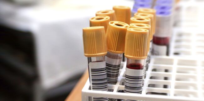 Les médecins prudents face à un nouveau vaccin contre le VIH