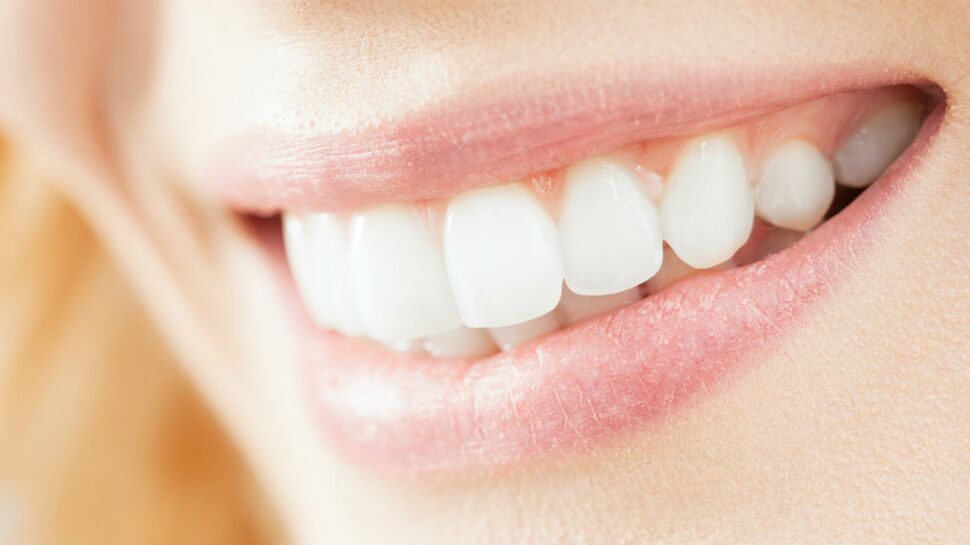 Ce qu’il faut savoir sur les couronnes dentaires