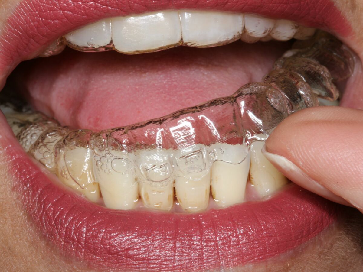 Protège-dents Dents Avec Bagues Transparentes Alignement Des Dents Par  Gouttières Dentisterie Orthodontique