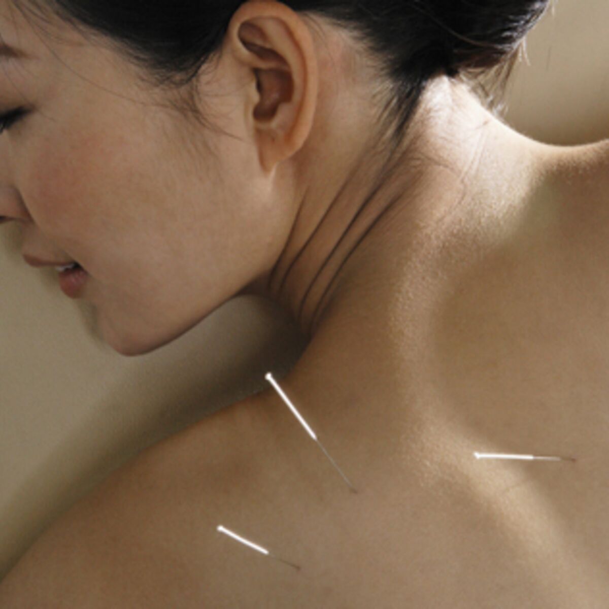 Acupuncture : une médecine chinoise qui a la cote : Femme Actuelle ...