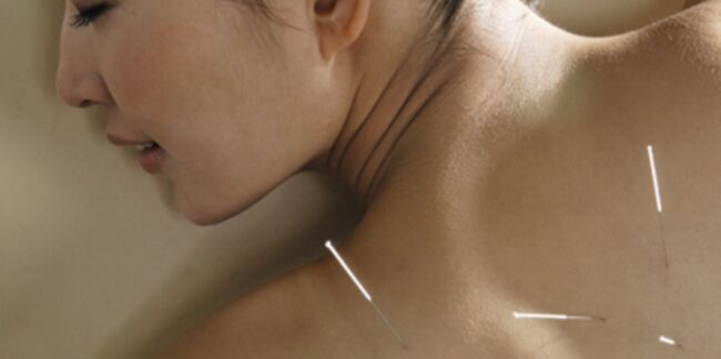 Acupuncture : une médecine chinoise qui a la cote