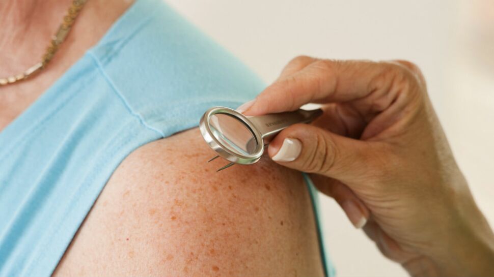 Dermatologie : les bobos de la peau à soigner avant l'été