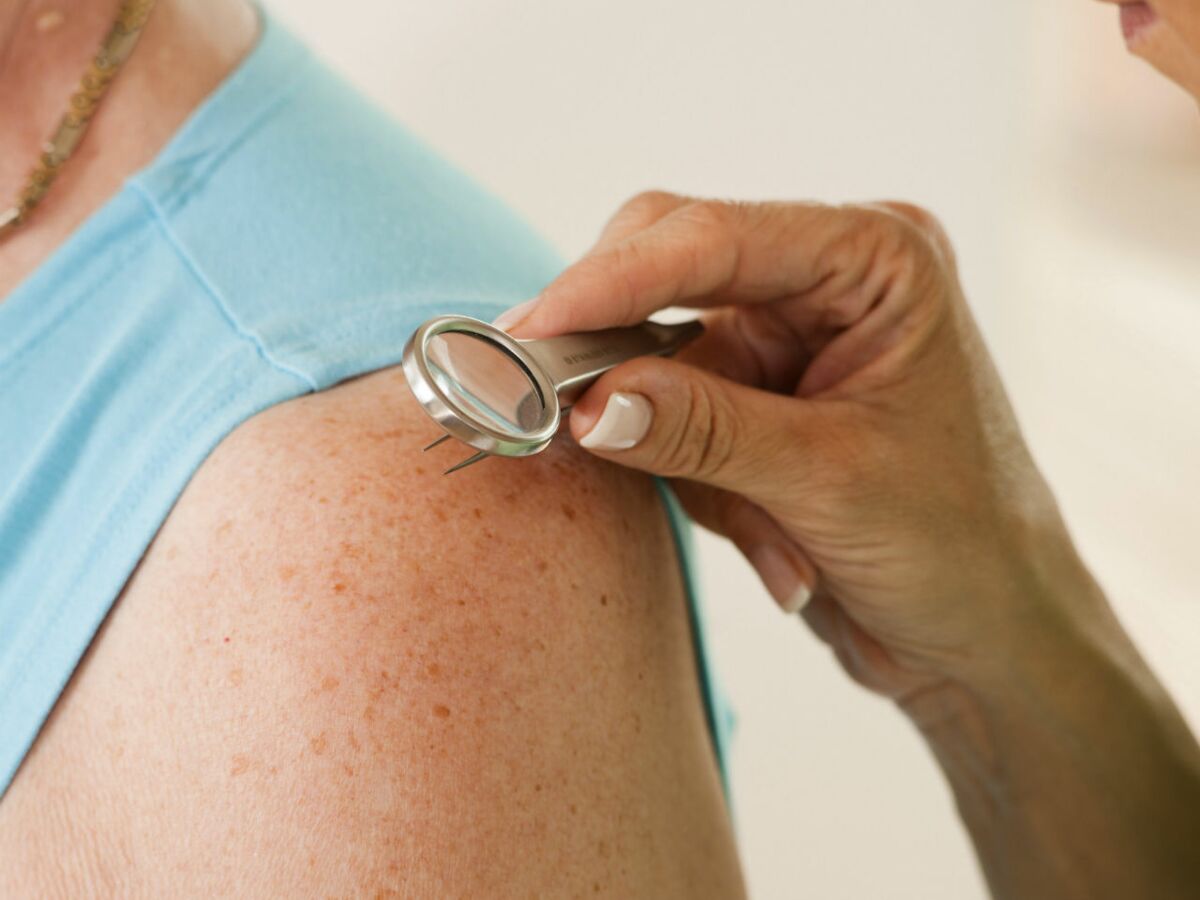 Dermatologie : les bobos de la peau à soigner avant l'été : Femme ...