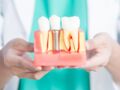 Vrai / Faux : 10 idées reçues sur les implants dentaires