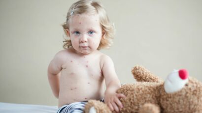 Epidemie De Varicelle Les Bons Reflexes A Adopter Si Votre Enfant L A Attrapee Femme Actuelle Le Mag