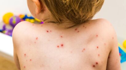 Comment Differencier La Rougeole De La Varicelle Femme Actuelle Le Mag