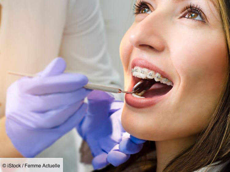 Orthodontie pour adulte : le business de l'appareil dentaire