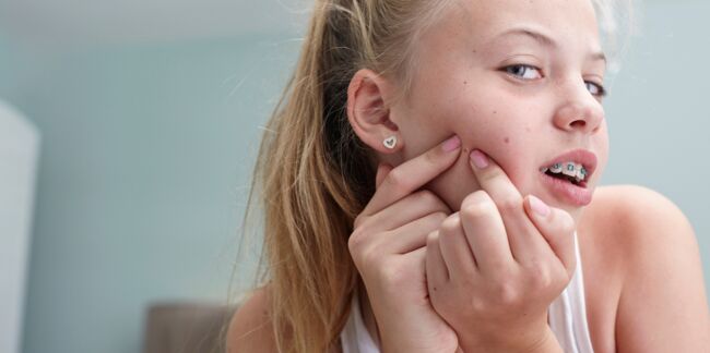 Peut-on se faire vacciner contre l'acné ?