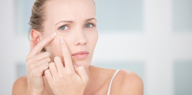 Pourquoi a-t-on plus d’acné en hiver et comment y remédier?