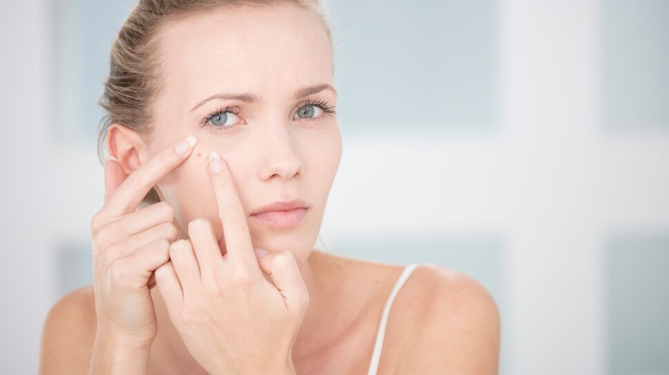 Pourquoi a-t-on plus d’acné en hiver et comment y remédier?