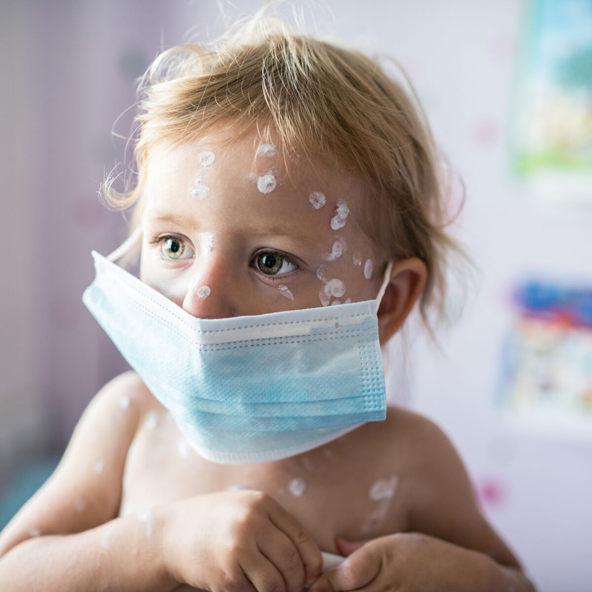 Impetigo Comment Reconnaitre Les Symptomes De Cette Maladie Contagieuse Femme Actuelle Le Mag