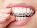 Gouttières dentaires : des orthodontistes mettent en garde contre les dérives