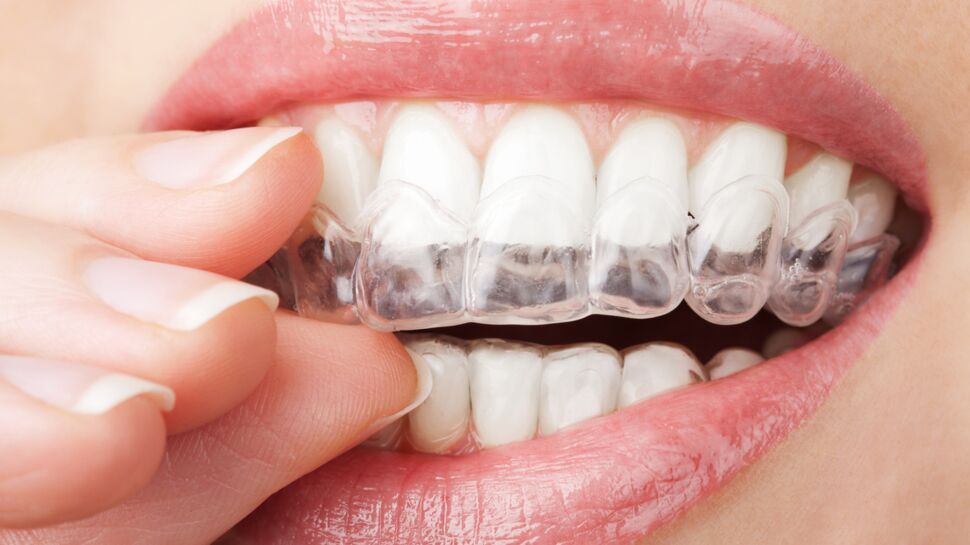 Gouttières dentaires : des orthodontistes mettent en garde contre les dérives
