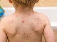 Comment différencier la rougeole de la varicelle ?