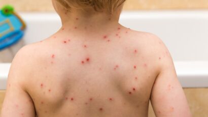 Boutons de varicelle : 10 astuces naturelles pour éviter les ...