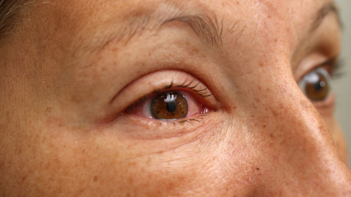 Conjonctivite, allergies : 8 bon réflexes pour soigner ses yeux ...