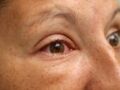 Conjonctivite, allergies : 8 bon réflexes pour soigner ses yeux