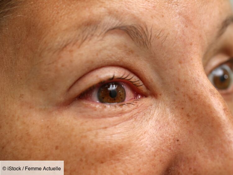 Conjonctivite, allergies : 8 bon réflexes pour soigner ses yeux ...