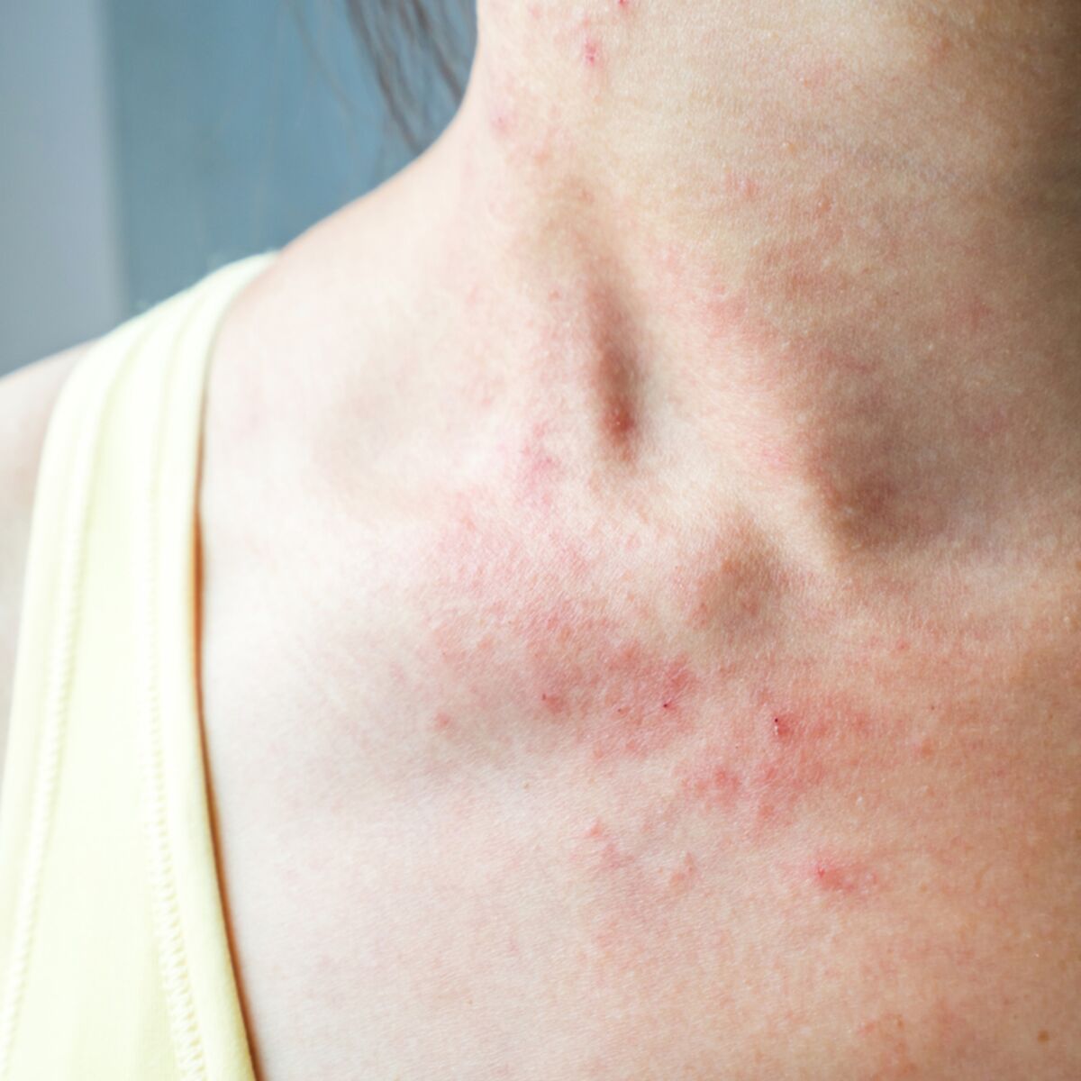 Allergie Aux Piqures De Moustiques Ces Signes Qui Ne Trompent Pas Femme Actuelle Le Mag