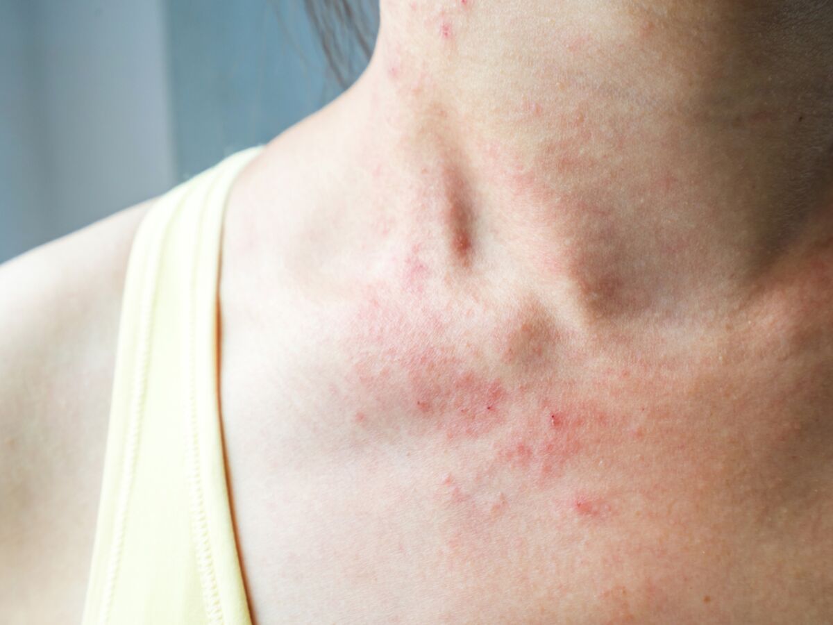 Allergie Aux Piqures De Moustiques Ces Signes Qui Ne Trompent Pas Femme Actuelle Le Mag