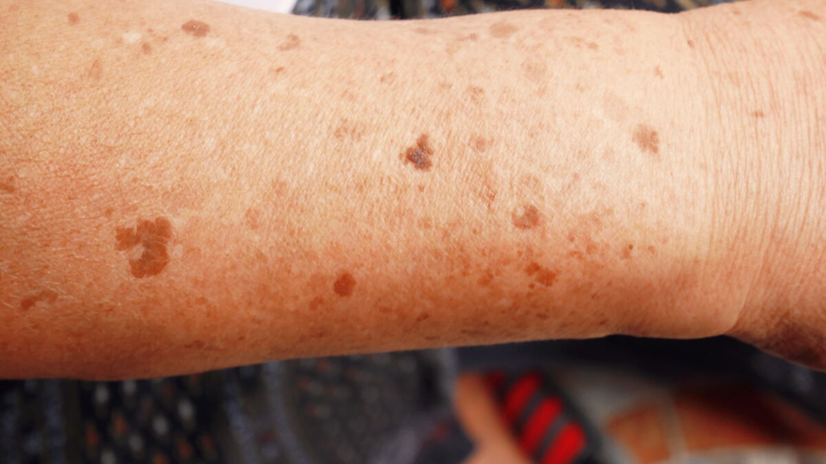 Pityriasis Versicolor Attention A Ce Champignon De L Ete Responsable De Taches Brunes Femme Actuelle Le Mag