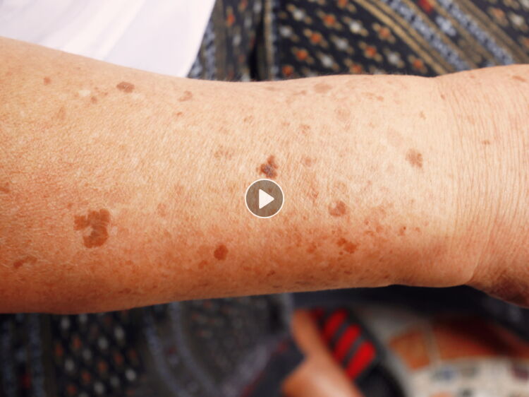 Pityriasis versicolor attention à ce “champignon de l’été” responsable de taches brunes