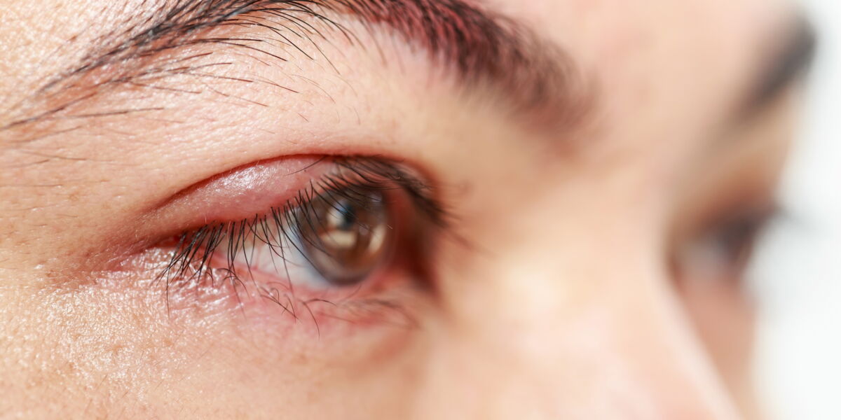 Les Solutions Pour Traiter Un Orgelet Femme Actuelle Le Mag