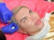 Rodrigo Alves : après 11 rhinoplasties, le “Ken humain”, a peur que son nez s’effondre