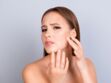 Alimentation, stress, soins dermatologiques : les facteurs qui favorisent l’acné