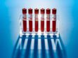 Bientôt un test sanguin pour prévenir la rupture d’anévrisme ?