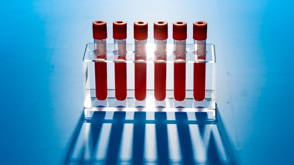 Bientôt un test sanguin pour prévenir la rupture d’anévrisme ?