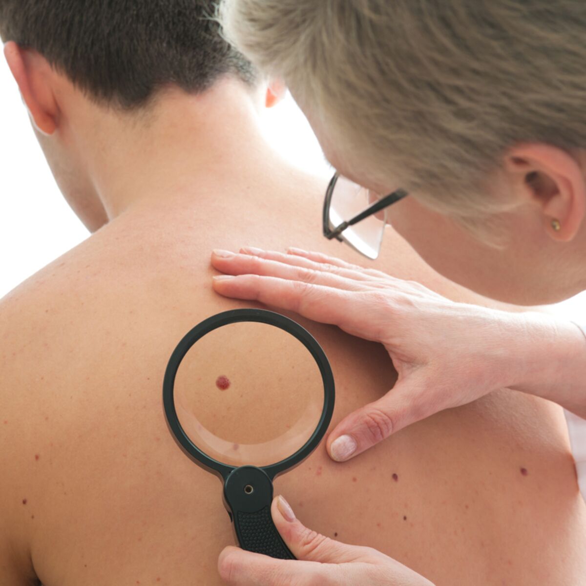 Une cicatrice peut-elle dégénérer en cancer de la peau ? : Femme ...
