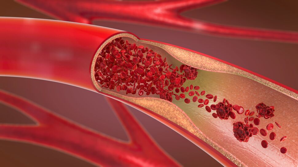Vascularites : ce qu’il faut savoir sur ces maladies inflammatoires des vaisseaux sanguins