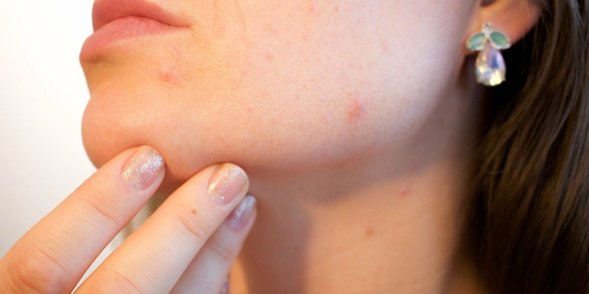 Des Medecines Douces Pour Traiter L Acne Femme Actuelle Le Mag