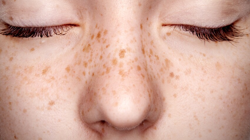 Taches De Rousseur Au Henne Le Phenomene Qui Fait Fureur Sur Les Reseaux Est Il Dangereux Femme Actuelle Le Mag