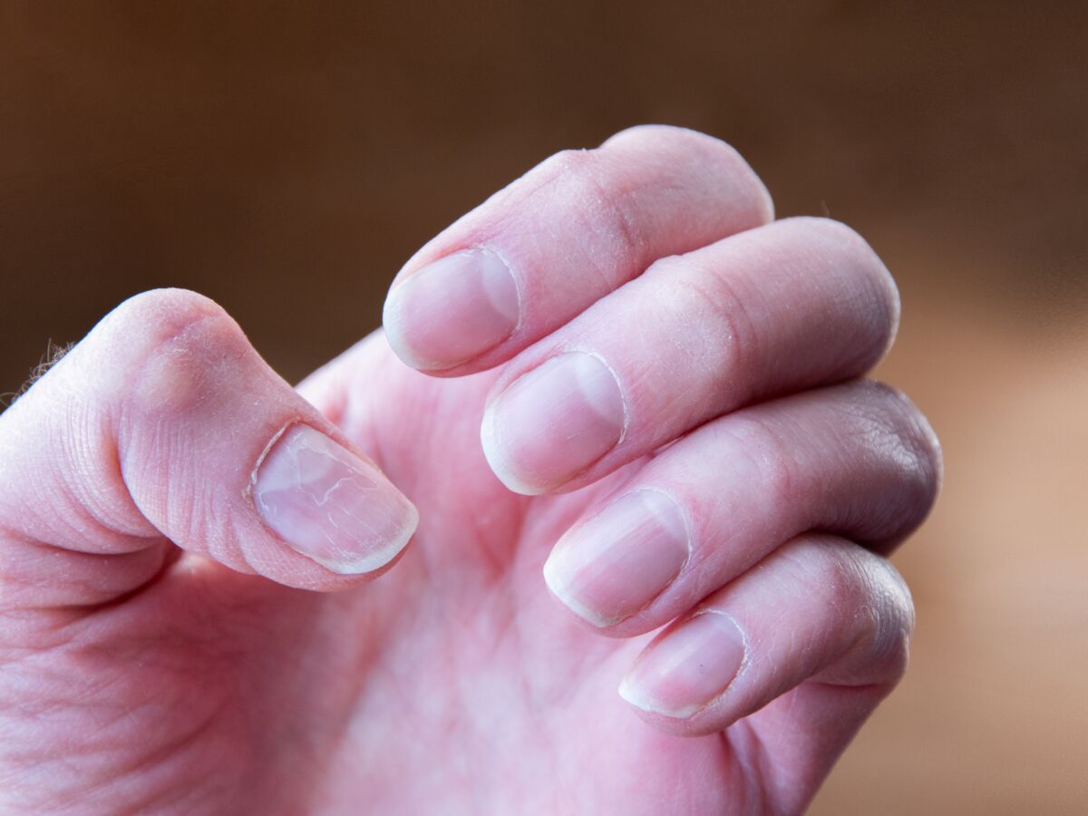 Ongles Covid Ce Test Tout Simple Pourrait Confirmer Que Vous Avez Ete Infecte Par Le Virus Femme Actuelle Le Mag Ongles Covid Ce Test Tout Simple Pourrait Confirmer Que Vous Avez Ete Infecte Par Le Virus Femme Actuelle Le Mag