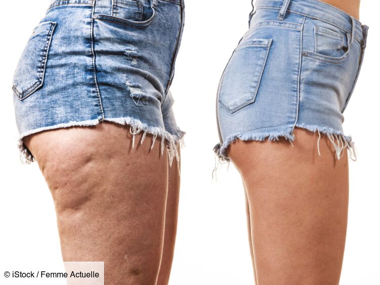 comment diminuer la cellulite sur les cuisses