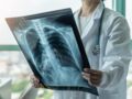 Nodule au poumon : symptômes, opération, traitements
