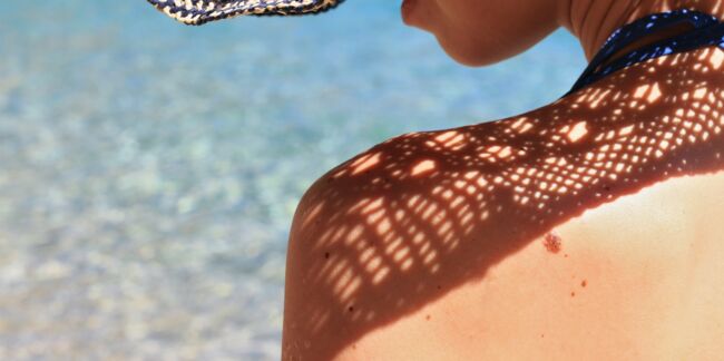 Taches solaires : comment leur faire la peau