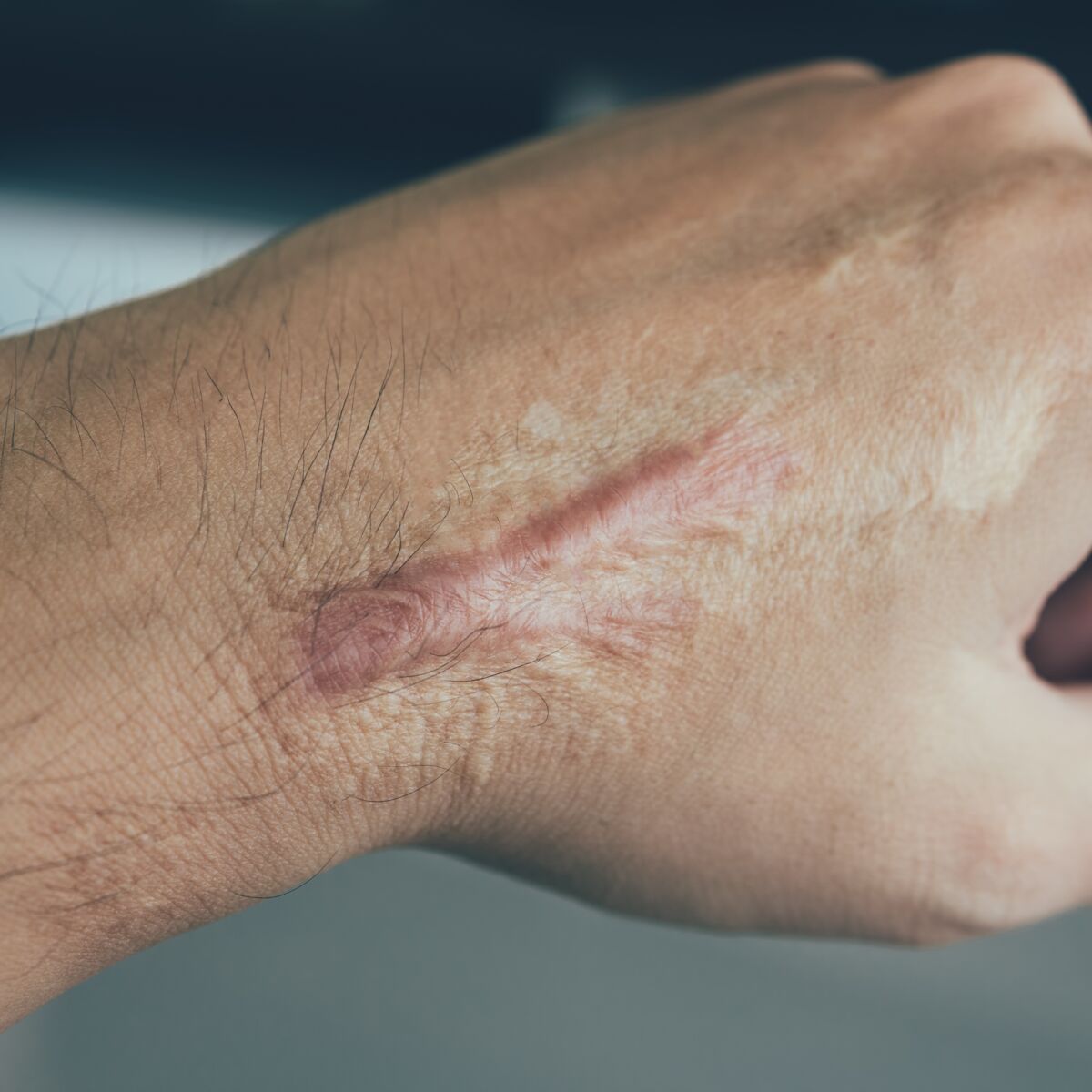 Cicatrices, comment améliorer la cicatrisation ?