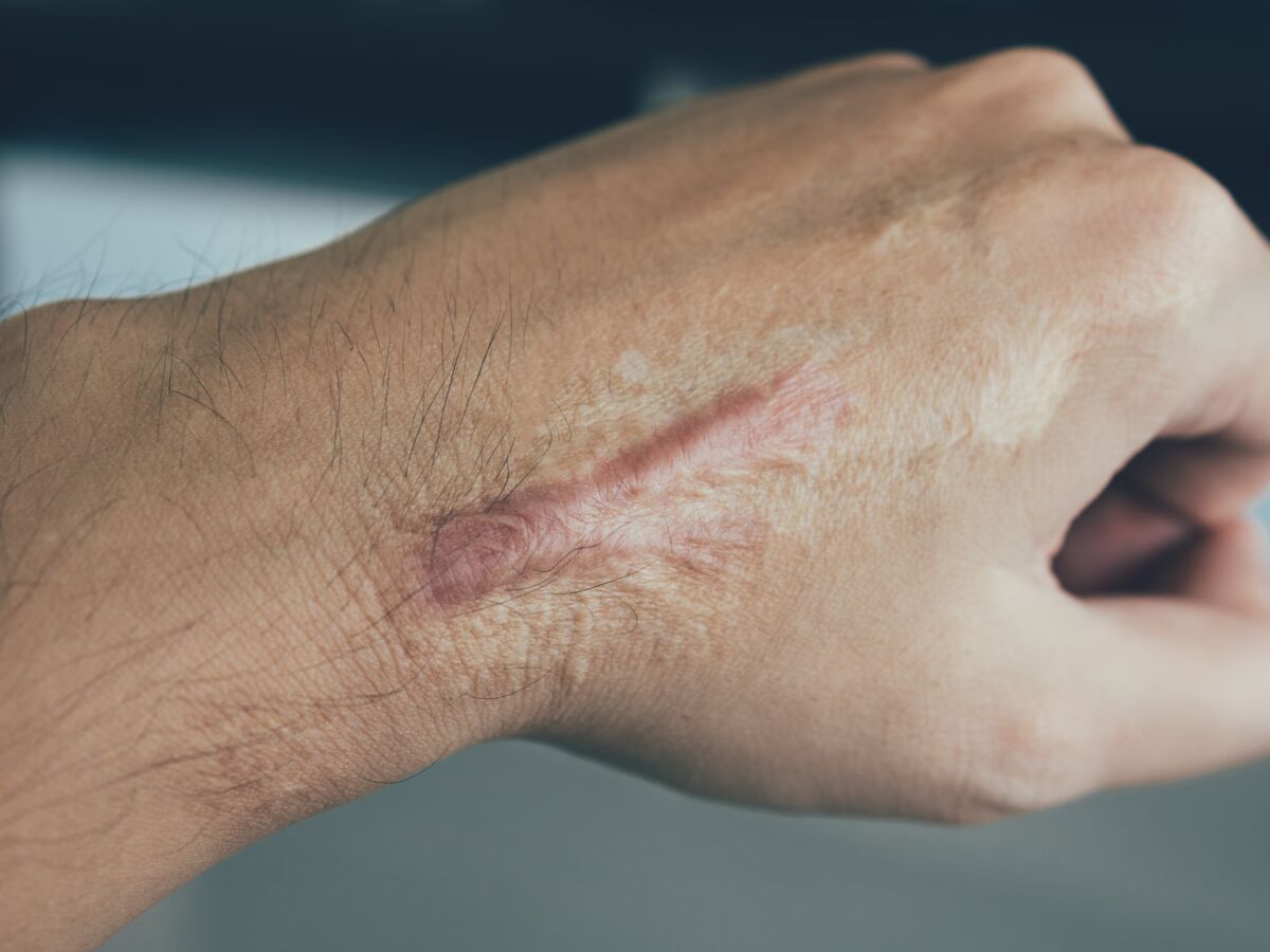 Cicatrice chéloïde : définition, symptômes et traitements