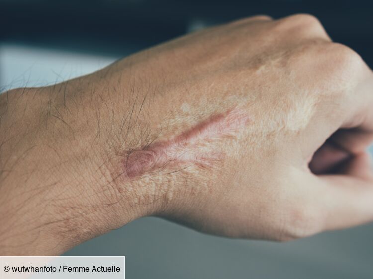 Cicatrice chéloïde : les meilleures traitements pour les atténuer