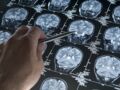 Prédire Alzheimer avant les premiers symptômes, c'est pour bientôt ?