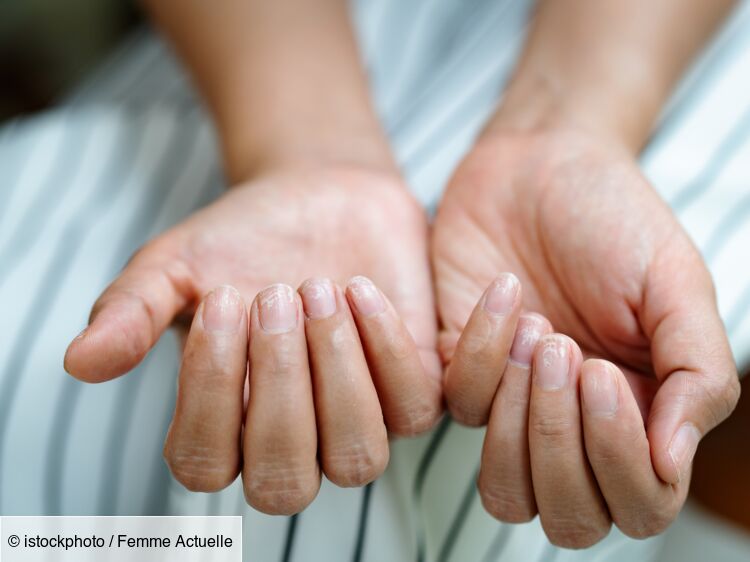 Ongles striés : comment les traiter et les protéger ?