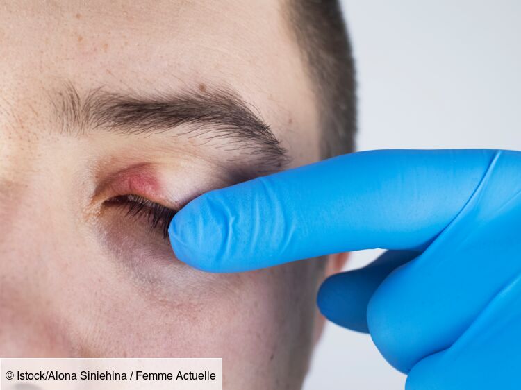 Chalazion contagion, symptômes, différence avec traitements Femme Actuelle Le MAG