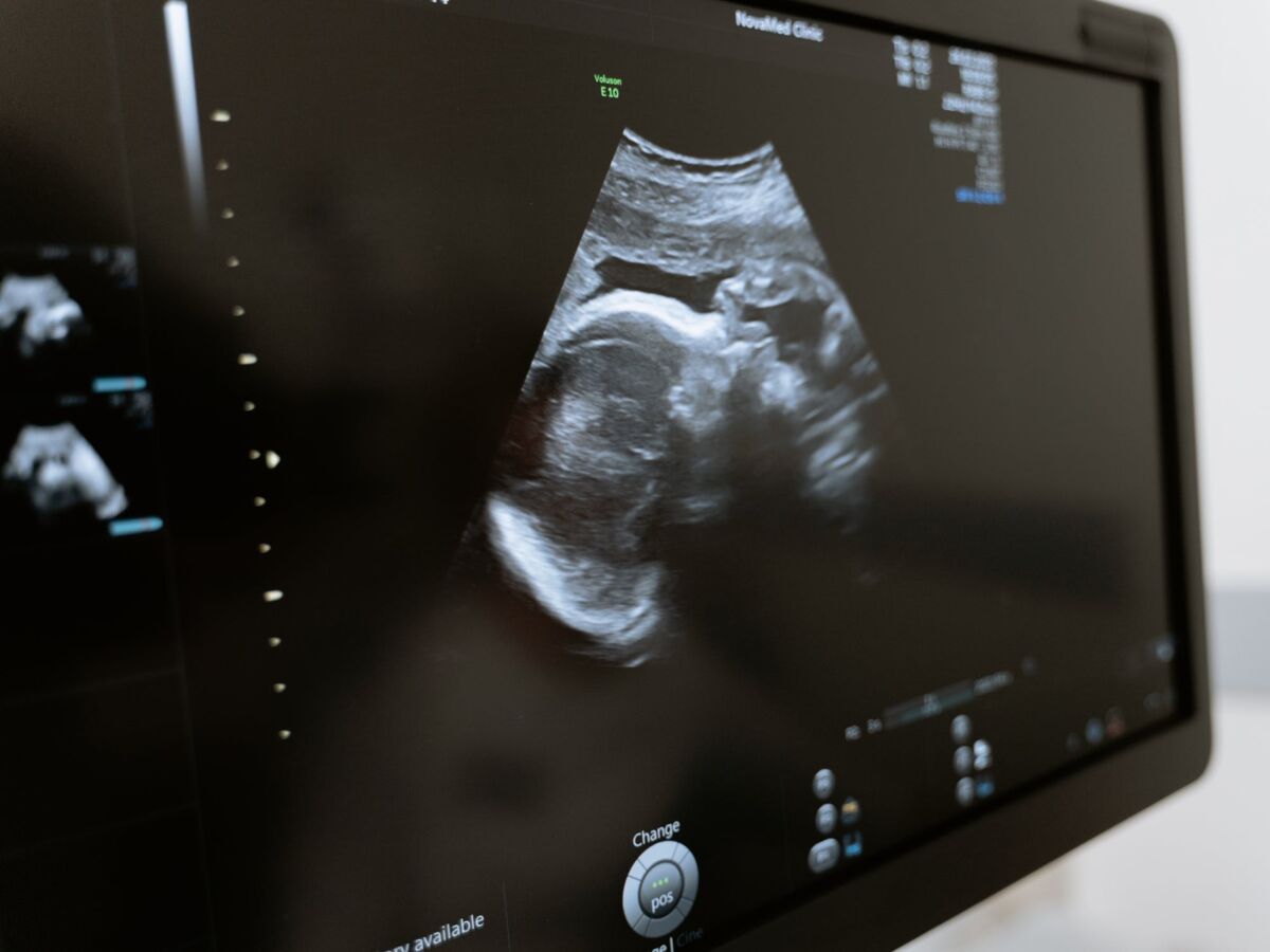 Echographie obstétricale du PREMIER TRIMESTRE de la grossesse sans
