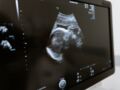 Échographie de grossesse :  quand, à quelle fréquence et comment cela se passe ?