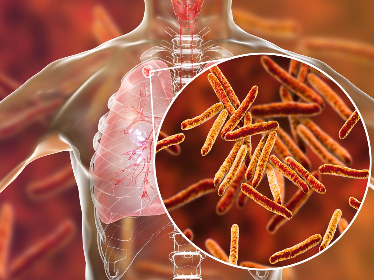Tuberculose : premiers symptômes, traitements et conséquences