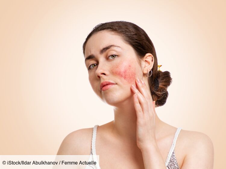 Couperose : causes, traitements et différences avec la rosacée : Femme ...