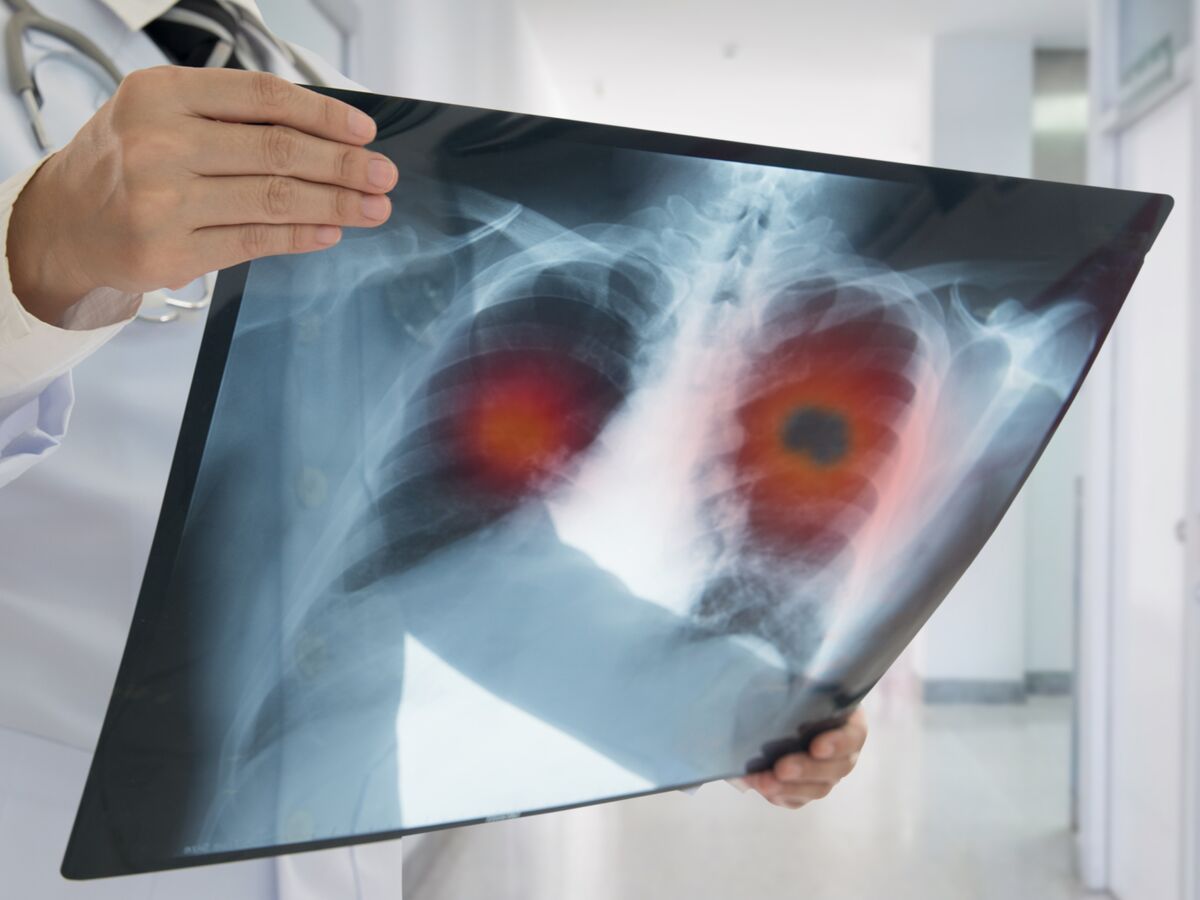 Cancer Du Poumon Causes Symptomes Traitements Et Guerison Femme Actuelle Le Mag